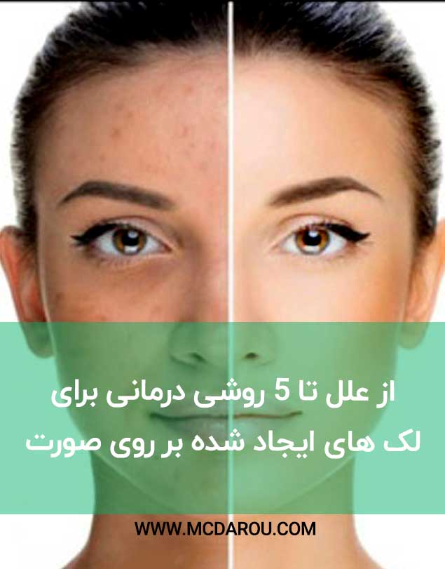 از علل تا 5 روشی درمانی برای لک های ایجاد شده بر روی صورت